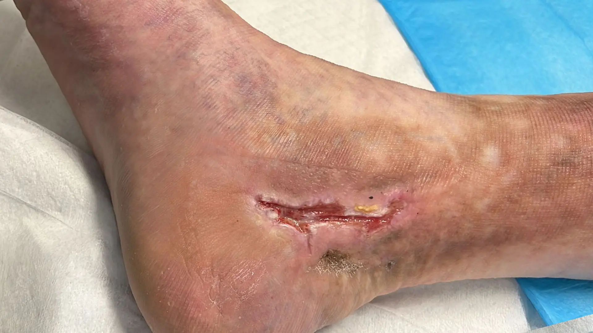 Venous Ulcer Care Tucson